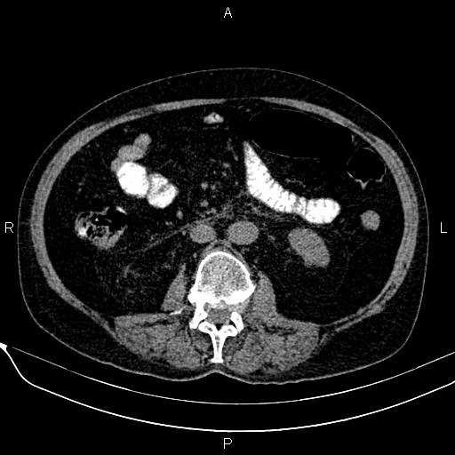 Acute pancreatitis (Radiopaedia 85146-100701 Axial non-contrast 65).jpg