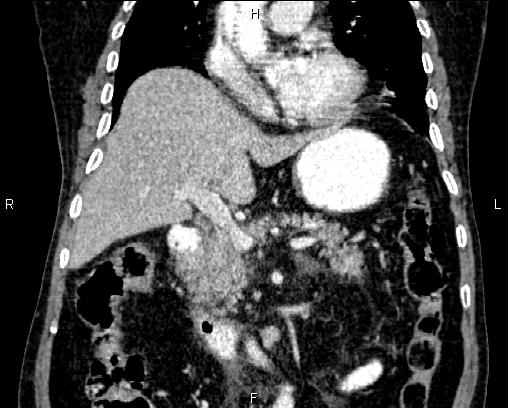 Acute pancreatitis (Radiopaedia 85146-100701 Coronal C+ portal venous phase 35).jpg