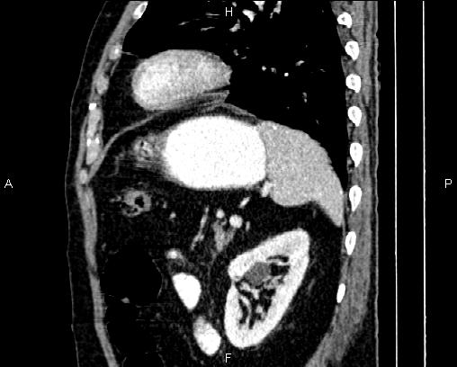 Acute pancreatitis (Radiopaedia 85146-100701 Sagittal C+ portal venous phase 71).jpg
