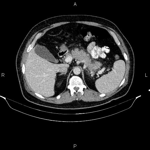 Acute pancreatitis (Radiopaedia 85390-101010 Axial C+ portal venous phase 31).jpg
