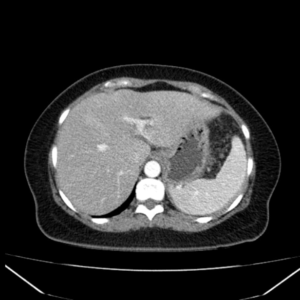 Acute pancreatitis - Balthazar C (Radiopaedia 26569-26714 Axial C+ arterial phase 18).jpg