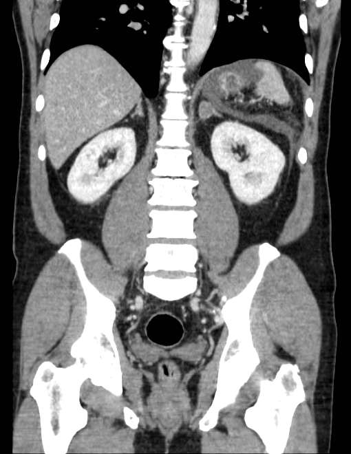 Acute pancreatitis - Balthazar E (Radiopaedia 23080-23110 Coronal C+ portal venous phase 54).jpg
