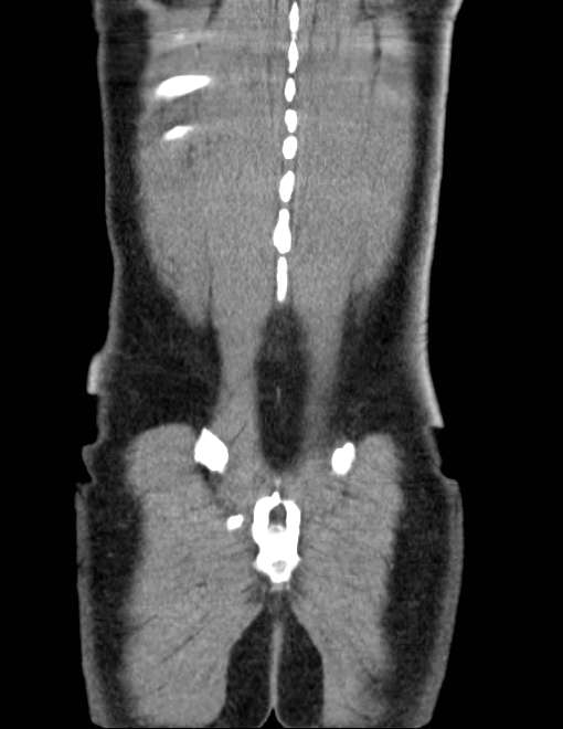 Acute pancreatitis - Balthazar E (Radiopaedia 23080-23110 Coronal C+ portal venous phase 76).jpg
