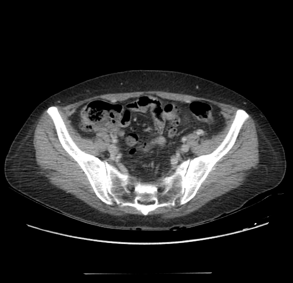 File:Acute pancreatitis - Balthazar E - post ERCP (Radiopaedia 27562-27772 Axial C+ portal venous phase 60).png