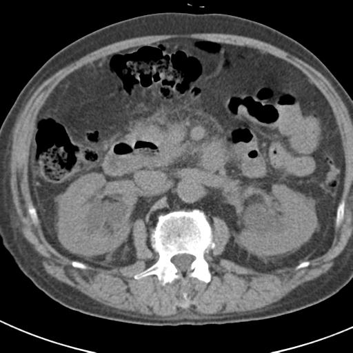 File:Acute pancreatitis and walled-off necrosis (Radiopaedia 29888-30403 Axial non-contrast 29).jpg