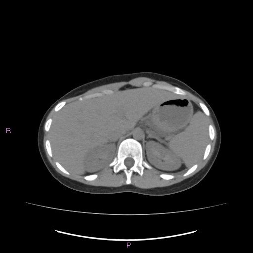 Acute pancreatitis secondary to stone at minor papilla and pancreatic divisum (Radiopaedia 76570-88333 Axial non-contrast 17).jpg