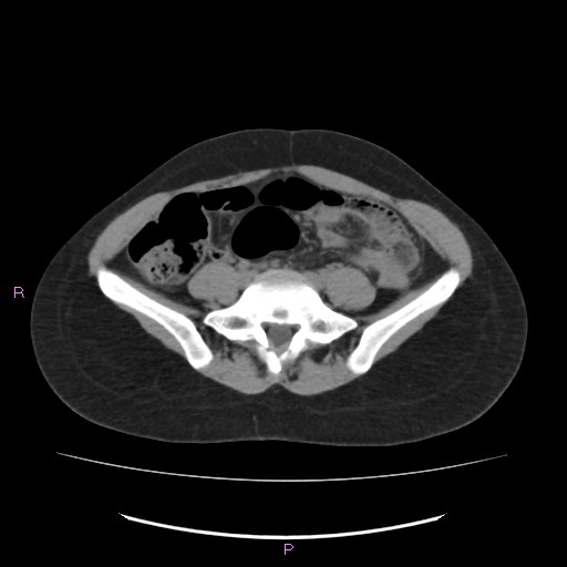 Acute pancreatitis secondary to stone at minor papilla and pancreatic divisum (Radiopaedia 76570-88333 Axial non-contrast 50).jpg