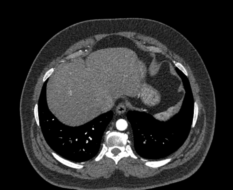 Acute pulmonary embolism with pulmonary infarcts (Radiopaedia 77688-89908 Axial C+ CTPA 56).jpg