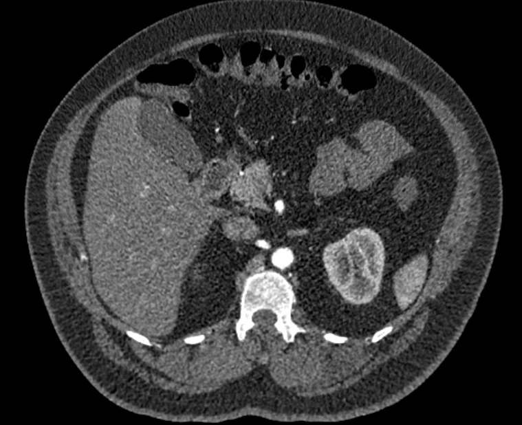 Acute pulmonary embolism with pulmonary infarcts (Radiopaedia 77688-89908 Axial C+ CTPA 85).jpg