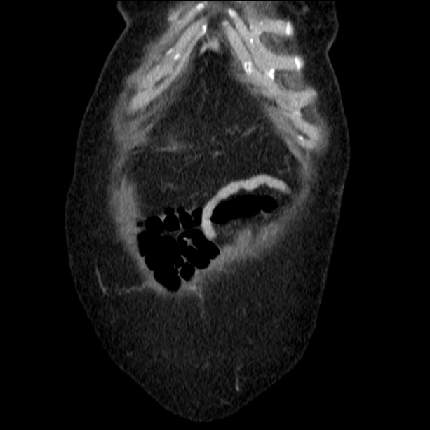 Acute pyelonephritis (Radiopaedia 26584-26729 C+ portal venous phase 11).jpg