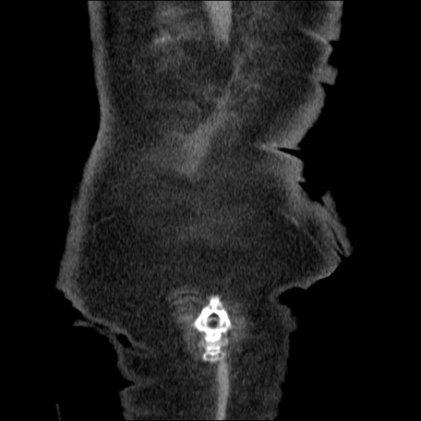 Acute pyelonephritis (Radiopaedia 26584-26729 C+ portal venous phase 72).jpg
