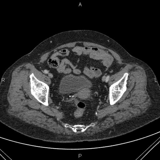 File:Acute renal artery occlusion (Radiopaedia 86586-102682 Axial C+ portal venous phase 86).jpg