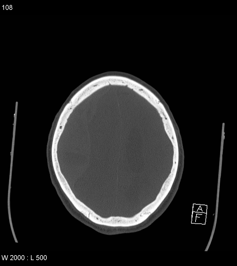 Acute subdural hematoma with myelofibrosis (Radiopaedia 52582-58494 Axial bone window 54).jpg