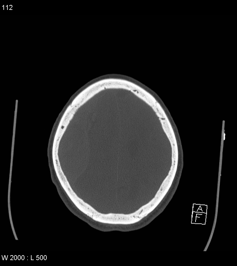 Acute subdural hematoma with myelofibrosis (Radiopaedia 52582-58494 Axial bone window 56).jpg