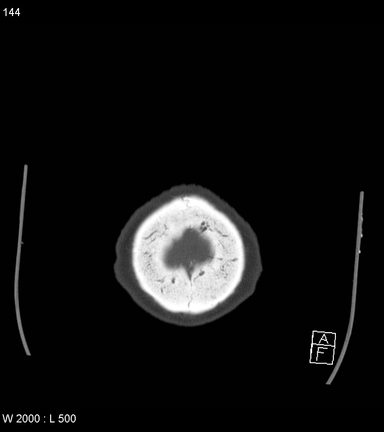 Acute subdural hematoma with myelofibrosis (Radiopaedia 52582-58494 Axial bone window 72).jpg
