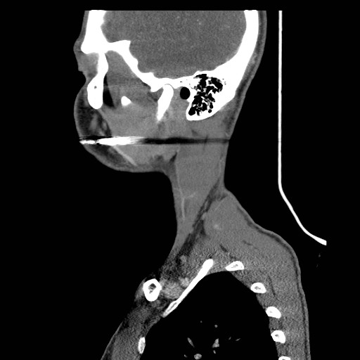 File:Acute submandibular sialadenitis secondary to ductal stone (Radiopaedia 27999-28267 Sagittal C+ delayed 39).jpg