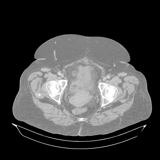 Acute superior mesenteric artery occlusion (Radiopaedia 51288-56960 Axial lung window 74).jpg
