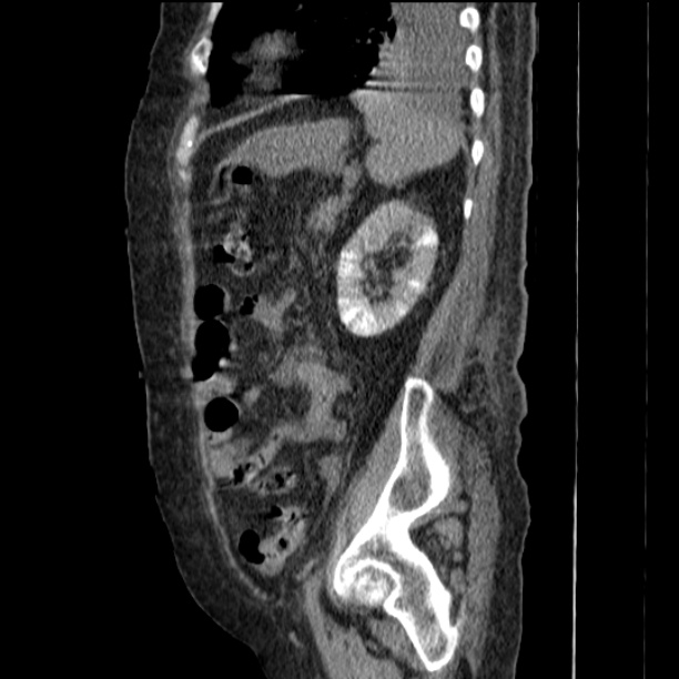 Acute tubular necrosis (Radiopaedia 28077-28334 Sagittal non-contrast 64).jpg