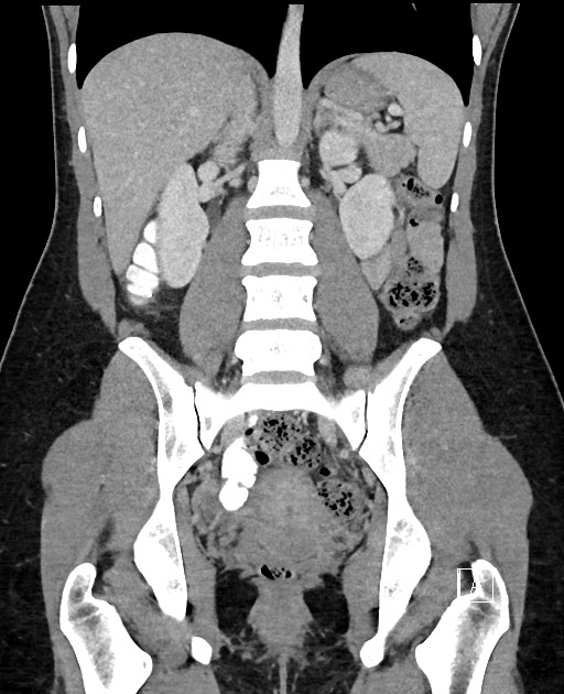 Acute uncomplicated appendicitis (Radiopaedia 61374-69304 Coronal C+ portal venous phase 63).jpg