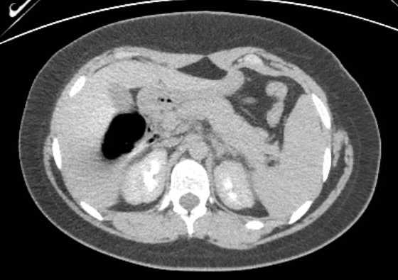 Acute unilateral nonhemorrhagic adrenal infarction (Radiopaedia 67560-76957 Axial renal excretory phase 33).jpg
