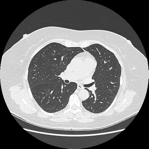 Adenocarcinoma in situ of lung (Radiopaedia 38685-40829 B 106).png