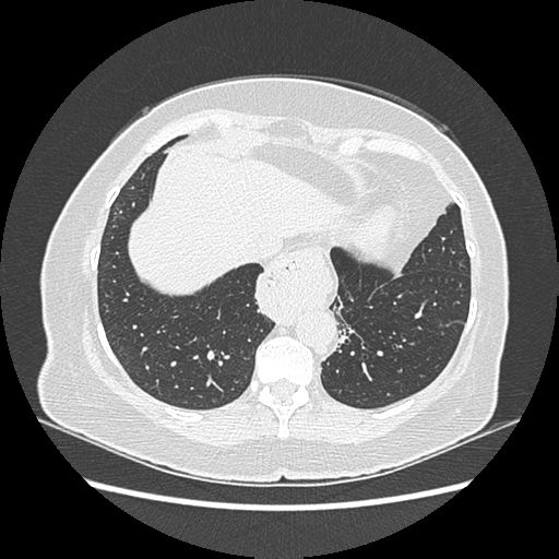 Adenocarcinoma in situ of lung (Radiopaedia 38685-40829 B 176).png