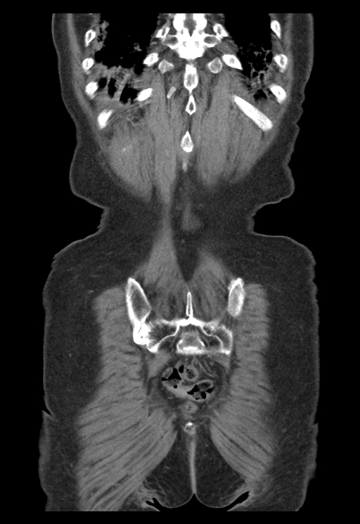 Adenocarcinoma of cecum (Radiopaedia 59222-66549 Coronal C+ portal venous phase 65).jpg