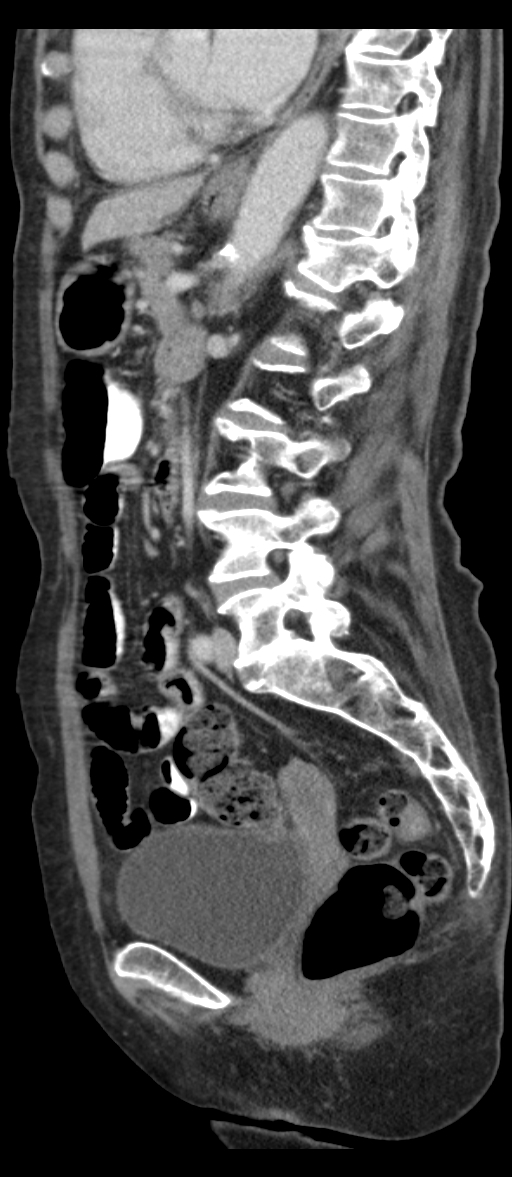 Adenocarcinoma of cecum (Radiopaedia 59222-66549 Sagittal C+ portal venous phase 38).jpg