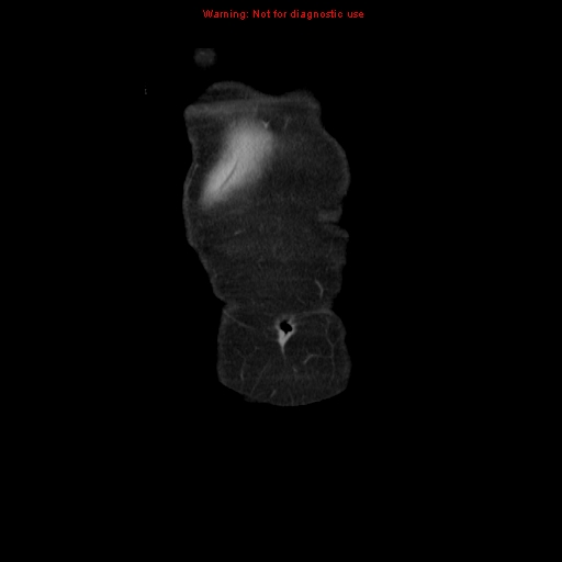 File:Adenocarcinoma of the colon (Radiopaedia 8191-9039 Coronal liver window 2).jpg