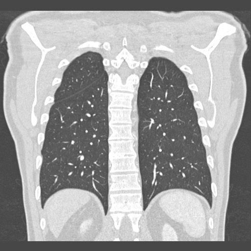 Adenocarcinoma of the lung (Radiopaedia 59871-67325 Coronal lung window 50).jpg