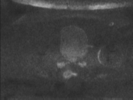Adenocarcioma of rectum- T1 lesion (Radiopaedia 36921-38546 Axial DWI 74).png