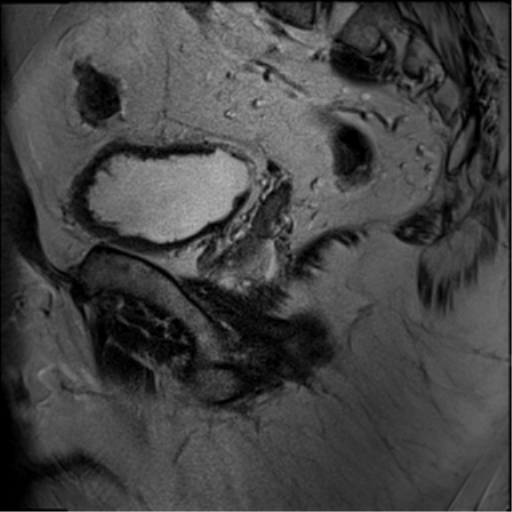 File:Adenocarcioma of rectum- T1 lesion (Radiopaedia 36921-38546 Sagittal T2 7).png