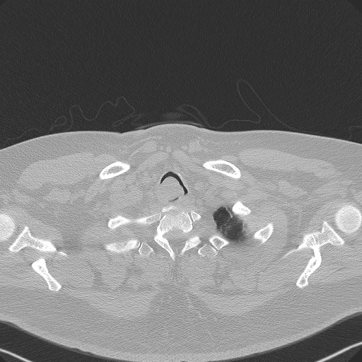 Adenoid cystic carcinoma of the trachea (Radiopaedia 49042-54137 Axial lung window 21).jpg