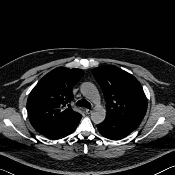 File:Adenoid cystic carcinoma of the trachea (Radiopaedia 49042-54137 Axial non-contrast 109).jpg