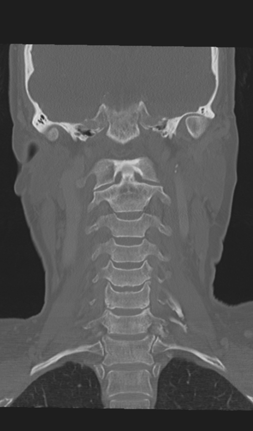 Adenoid cystic tumor of palate (Radiopaedia 46980-51518 Coronal bone window 39).png