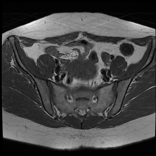 File:Adenomyosis-scar endometriosis (Radiopaedia 65863-75022 Axial T1 9).jpg