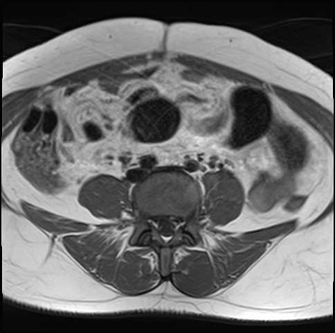 File:Adenomyosis - ovarian endometriomas (Radiopaedia 67031-76350 Axial T1 2).jpg