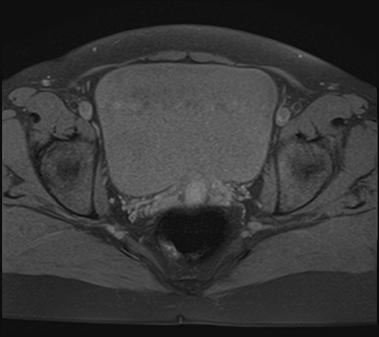 File:Adenomyosis - ovarian endometriomas (Radiopaedia 67031-76350 Axial T1 fat sat 19).jpg