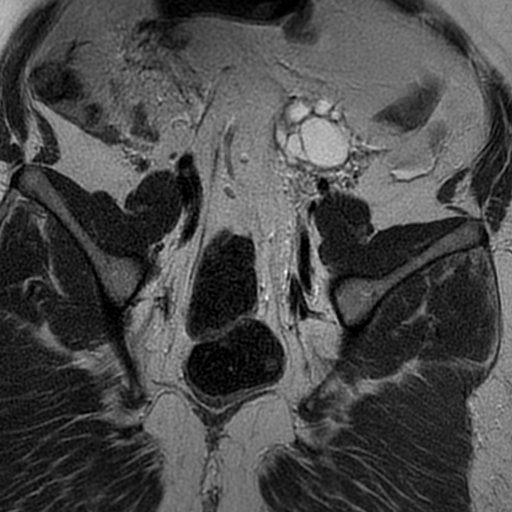 File:Adenomyosis within a didelphys uterus (Radiopaedia 70175-80215 Coronal T2 26).jpg