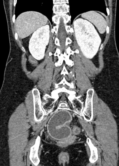 Adhesional small bowel obstruction (Radiopaedia 48397-53305 Coronal C+ portal venous phase 267).jpg