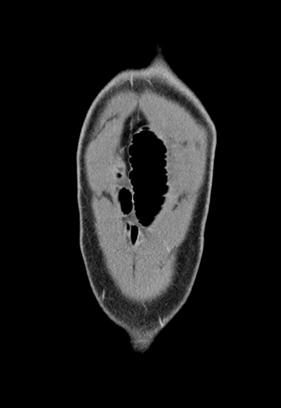 Adhesional small bowel obstruction (Radiopaedia 52107-57980 Coronal C+ portal venous phase 4).jpg