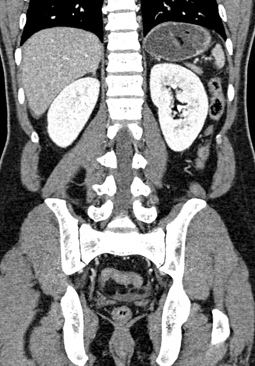 Adhesional small bowel obstruction (Radiopaedia 58900-66131 Coronal C+ portal venous phase 182).jpg