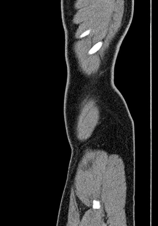 Adhesional small bowel obstruction (Radiopaedia 58900-66131 Sagittal C+ portal venous phase 10).jpg