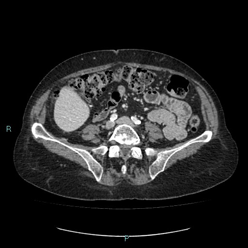 File:Adrenal collision tumor (ACT) (Radiopaedia 48462-53379 Axial C+ portal venous phase 39).jpg