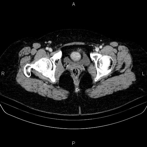 File:Adrenal cortical carcinoma (Radiopaedia 84882-100379 Axial C+ portal venous phase 94).jpg