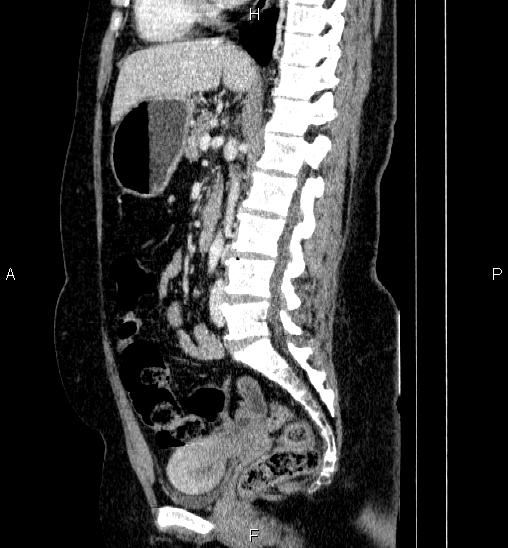 Adrenal cortical carcinoma (Radiopaedia 84882-100379 Sagittal C+ portal venous phase 46).jpg