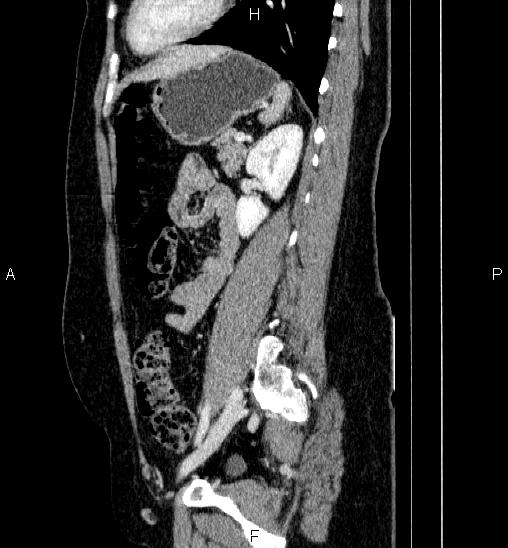 Adrenal cortical carcinoma (Radiopaedia 84882-100379 Sagittal C+ portal venous phase 60).jpg