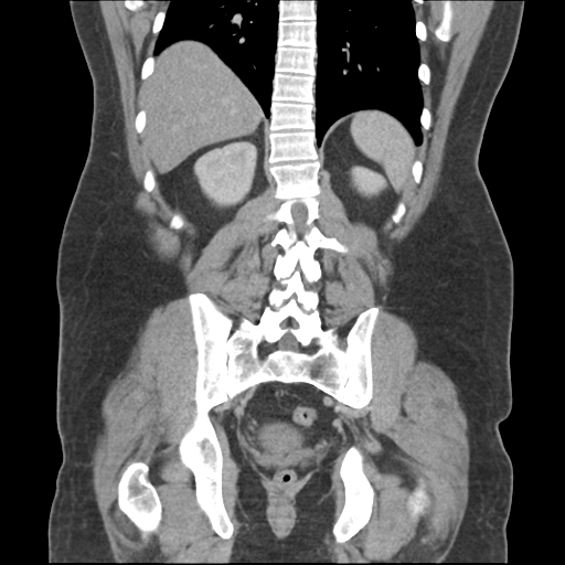 Adrenal cyst (Radiopaedia 45625-49776 Coronal C+ portal venous phase 53).png