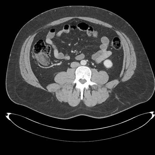File:Adrenal cyst (Radiopaedia 45625-49778 AXIAL THICK 60 sec 61).png