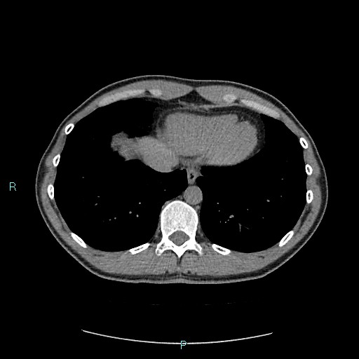 File:Adrenal cystic lymphangioma (Radiopaedia 83161-97534 Axial non-contrast 12).jpg